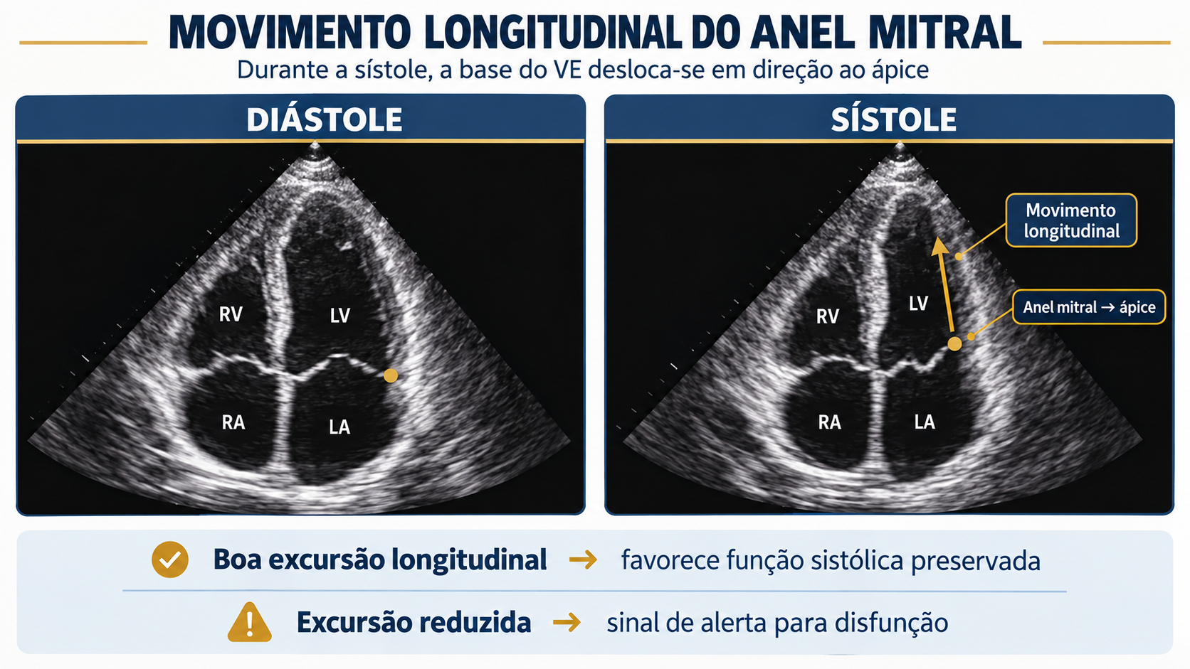 Janela apical de quatro câmaras ilustrando o deslocamento sistólico longitudinal do anel mitral em direção ao ápice.