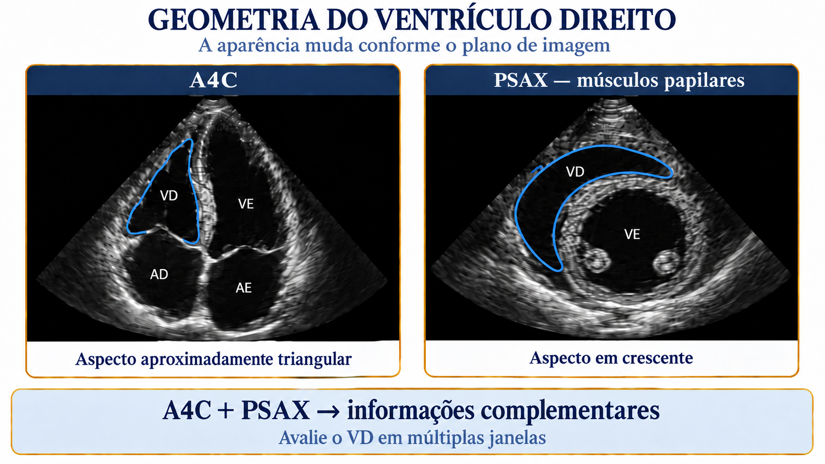 Ilustração da geometria do ventrículo direito em janela apical e eixo curto, demonstrando sua forma triangular e em crescente.