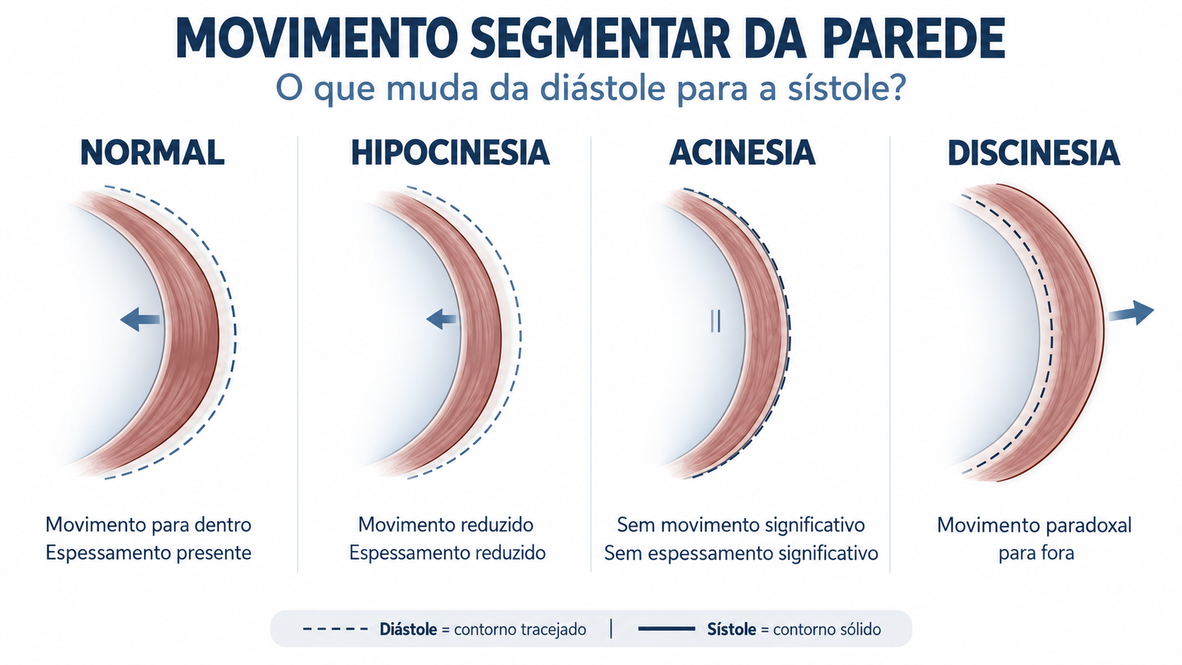 Diagrama comparando segmento miocárdico normal, hipocinético, acinético e discinético.