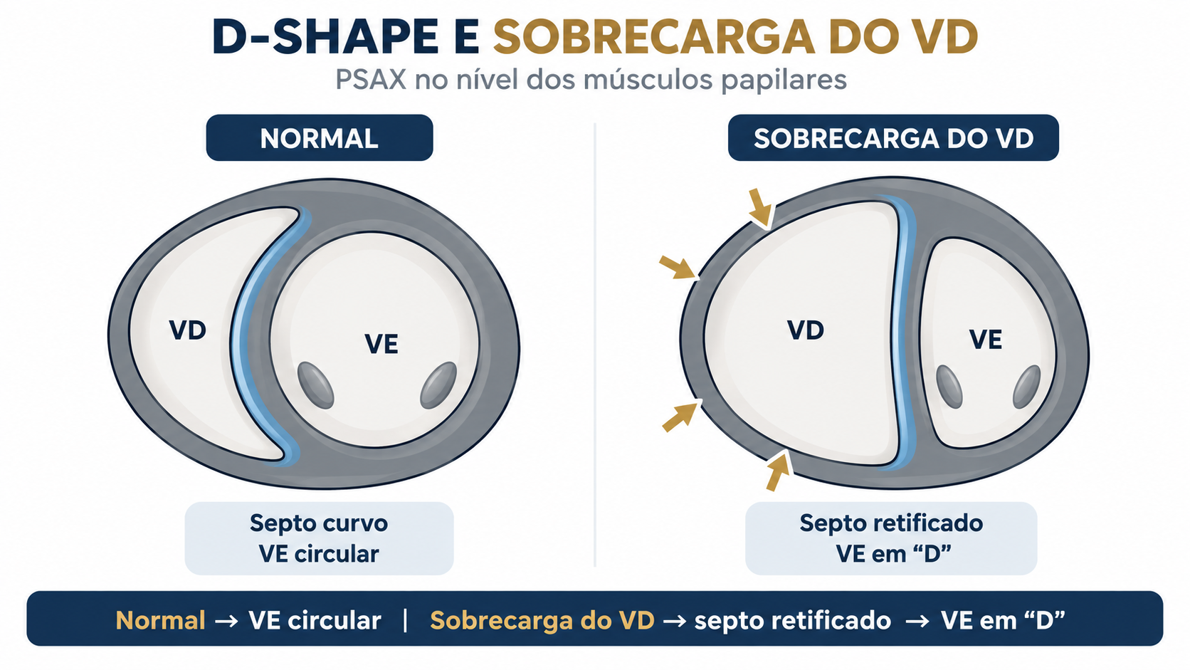 Esquema do D-shape em eixo curto demonstrando septo normal, sobrecarga pressórica do ventrículo direito e sobrecarga volumétrica.