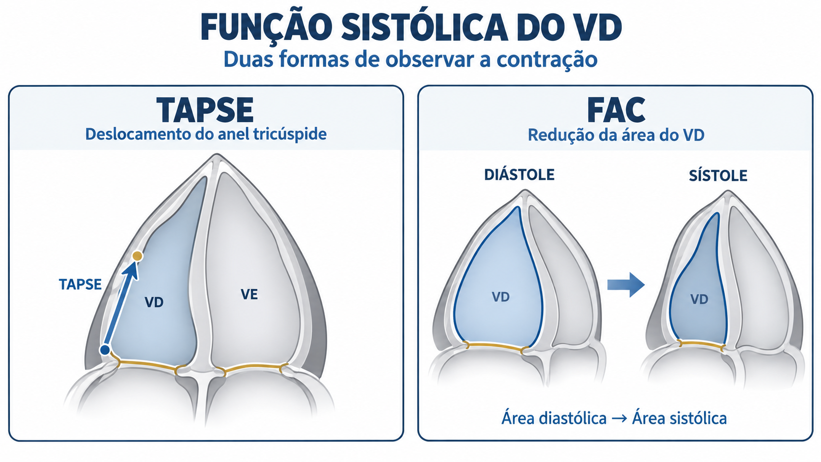 Imagem didática demonstrando como medir TAPSE e FAC do ventrículo direito.