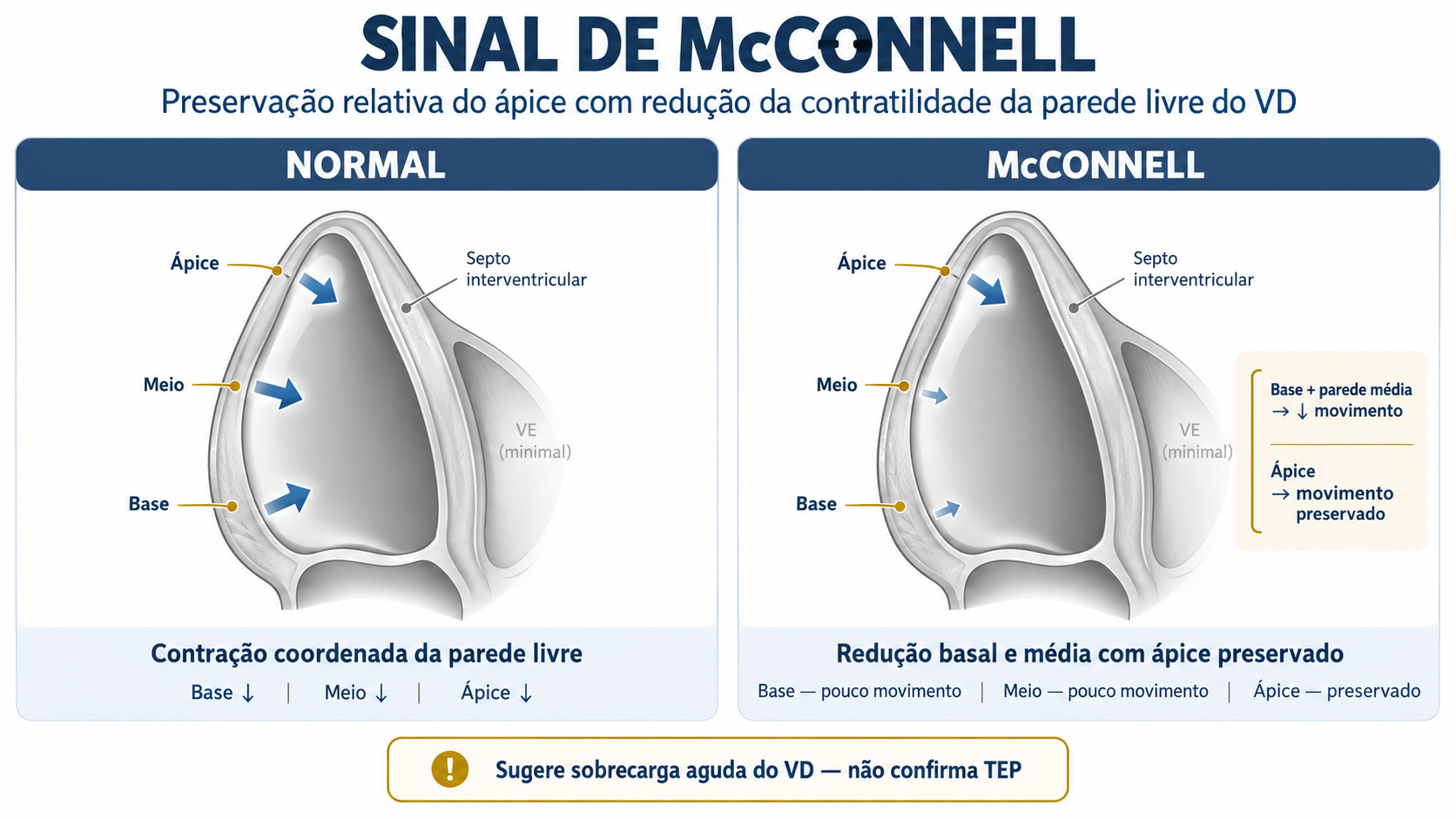 Esquema do sinal de McConnell com hipocinesia da parede livre do ventrículo direito e preservação relativa do ápice.