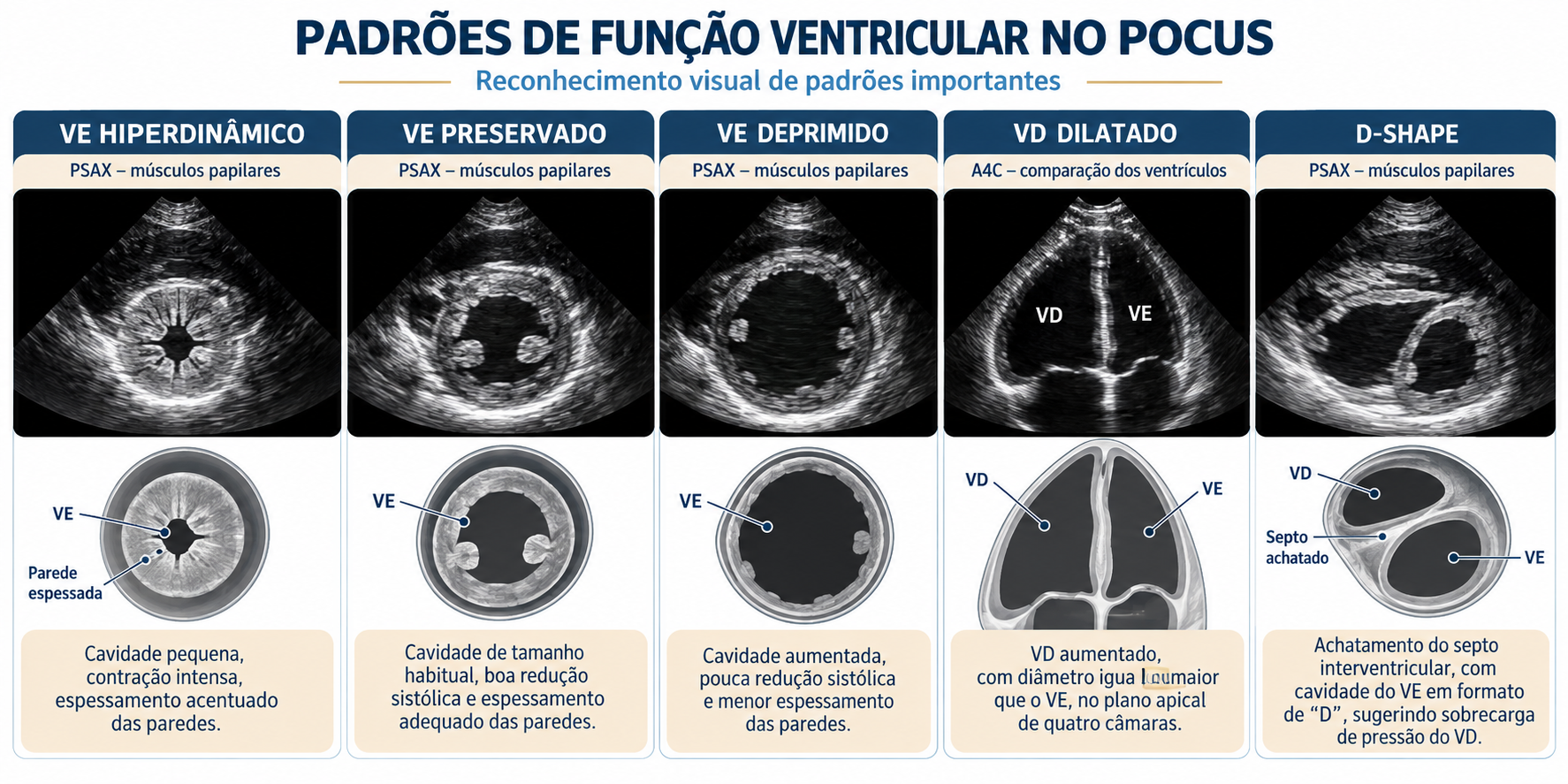 Mosaico didático com padrões de função ventricular no POCUS, incluindo VE hiperdinâmico, preservado e deprimido, VD dilatado e D-shape.