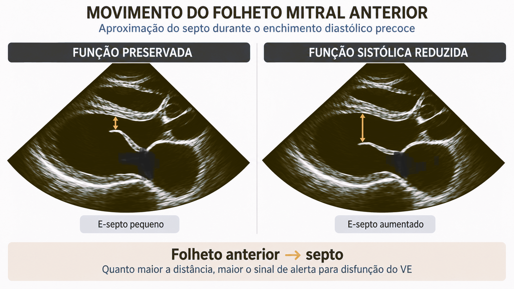 Esquema em PLAX mostrando movimento do folheto mitral anterior e a distância E-septo em função preservada e disfunção do ventrículo esquerdo.