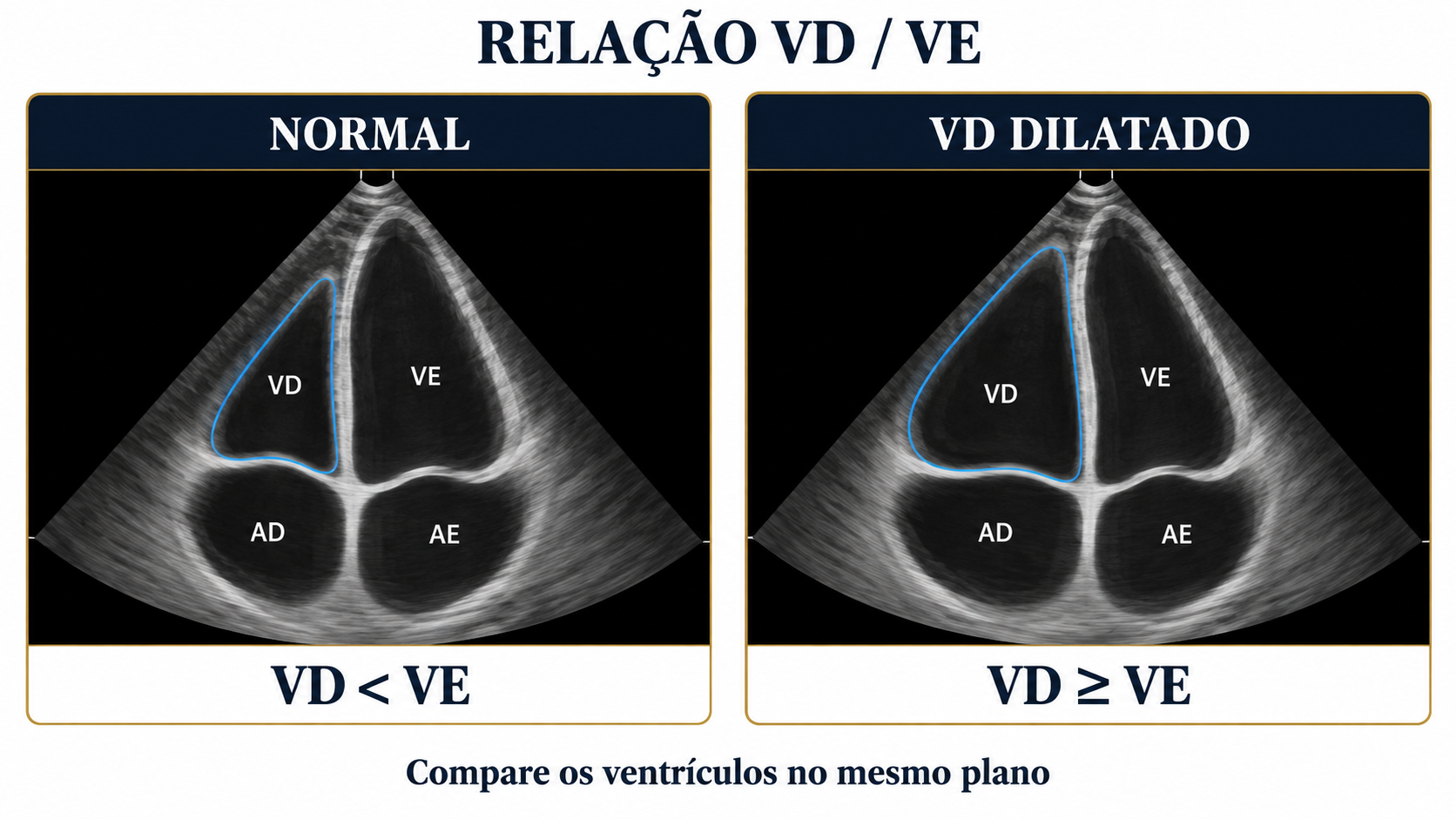 Comparação entre relação de tamanhos do ventrículo direito e esquerdo em janela apical de quatro câmaras.
